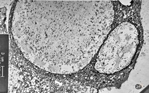 M,62y. | urinary bladder - cystitis cystica M,62y. | urinary bladder - cystitis cystica